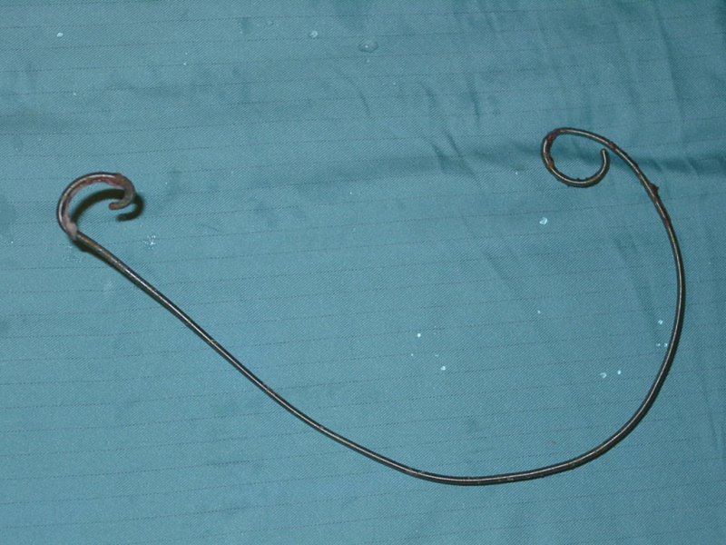 Stent removed at 1 year showing little encrustation