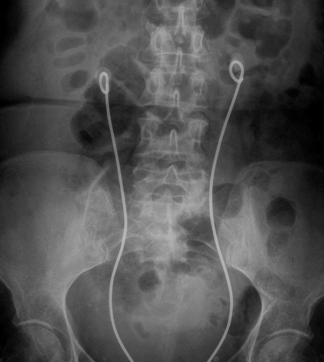 Incrustation in a stone forming patient