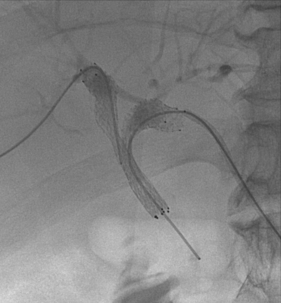 Hilar stricture stented with two Zilver stents