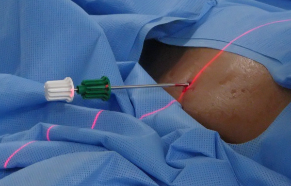 The Bonopty drill used to cut through the bone cortex.