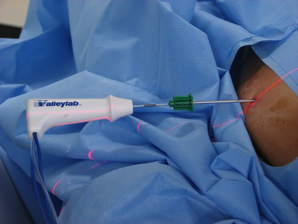 The Cool-tip needle is inserted through the Bonopty needle. In this case a fibula ostoid osteoma is being treated.