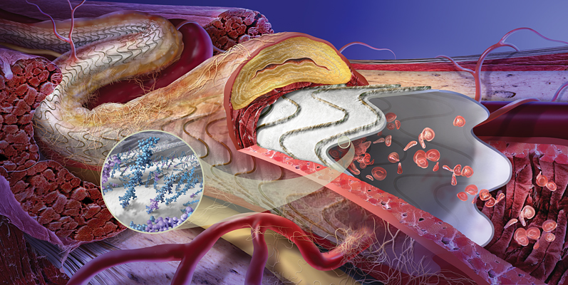 GORE VIABAHN Endoprosthesis