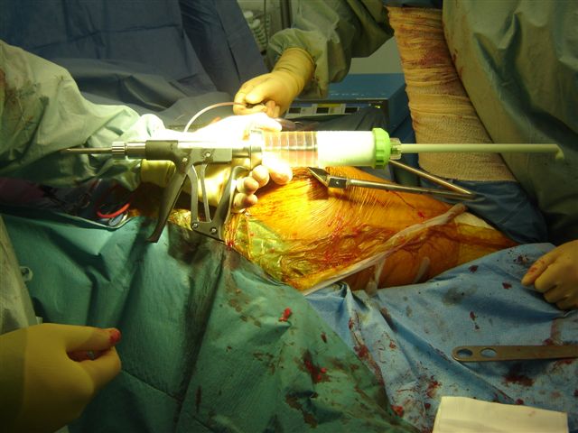 Figure 6. Loaded device just before cement insertion.