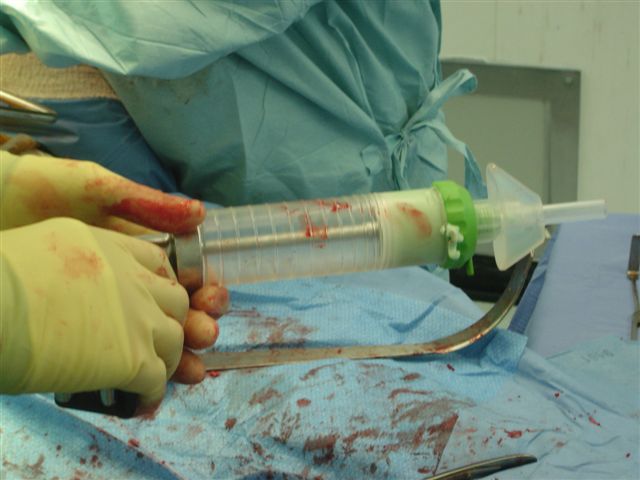 Figure 7. Loaded device showing cement extrusion from around cap