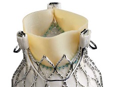 Engager Transcatheter Aortic Valve Implantation System