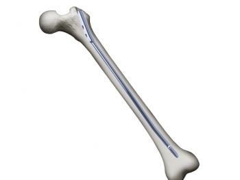 PediNail: image from Orthopediatrics