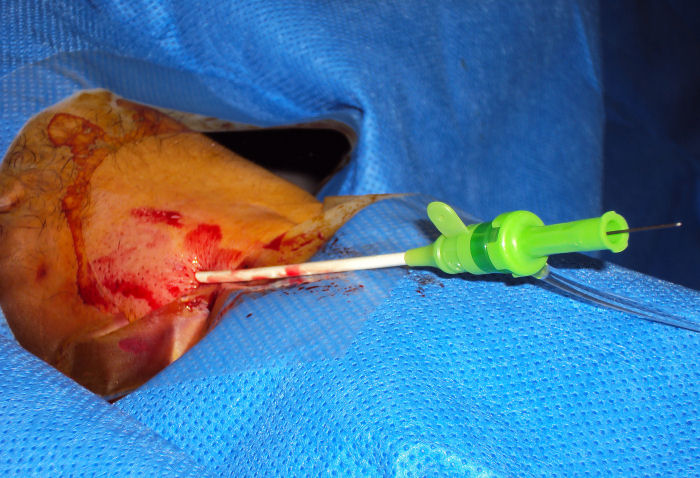 Sheath inserted