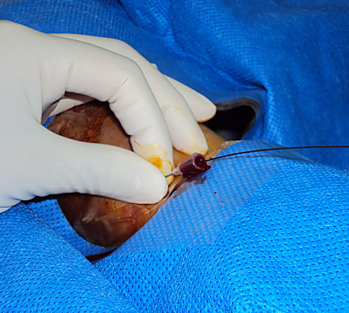 Needle insertion