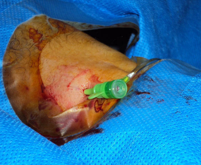 Sheath in situ