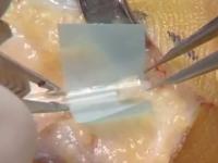 The Revolnerv device being implanted