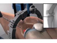 Subchondroplasty: image from Knee Creations