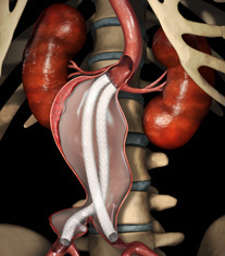 The Nellix Sealing Stent from Endologix