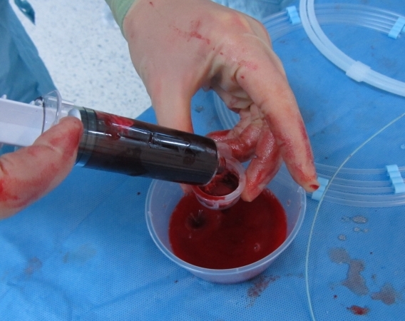 Pronto Extraction Catheter