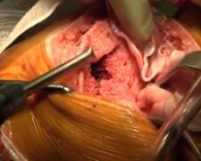 Kinamed Incorporated CarboJet Lavage | Used in Hip resurfacing, Knee replacement, Total ankle replacement, Total hip replacement | Which Medical Device