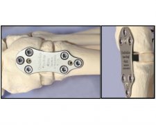 GraMedica Osteo-WEDGE | Used in First metatarsal osteotomy  | Which Medical Device