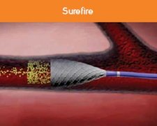 Surefire Medical Surefire Micro Catheter Infusion System | Used in Chemoembolisation, Embolisation, SIRT selective internal radiation therapy, TACE  | Which Medical Device