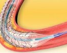 Biosensors International | BioMatrix Flex drug-eluting stent