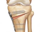 Arthrex ContourLock HTO Plates | Used in High tibial osteotomy | Which Medical Device