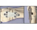 GraMedica Osteo-WEDGE | Used in First metatarsal osteotomy | Which Medical Device