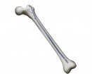 OrthoPediatrics PediNail Pediatric Femoral Nail | Used in Fracture fixation | Which Medical Device