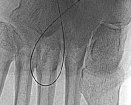 bantam-alpha-angioplasty.jpg