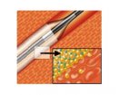 Medtronic IN.PACT Admiral Paclitaxel-eluting PTA Balloon | Used in Angioplasty, Fistuloplasty | Which Medical Device
