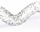 orbus-r-stent.jpg