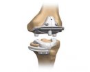 Smith & Nephew Visionaire Patient Matched Instrumentation | Used in Knee replacement | Which Medical Device