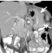 Figure 11: Gastric stent - Axial and coronal CT images demonstrating eccentric tumour infiltration of the greater curve of the stomach (arrows).