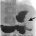 Figure 12: Contrast study showing a mid-gastric stricture (arrows).