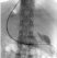 Figure 13 b: Insertion of the delivery system over a stiff guide wire placed in the duodenum.