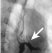 Figure 15: Iohexol swallow shows a large fistula into the left main bronchus (arrow).
