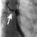 Figure 16a: Tracheo-oesophageal fistula outlined by contrast injection through a per-nasal catheter (patient prone).