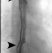 Figure 17: Contrast swallow shows sealing of the fistula, the stent markers (arrowheads) are obscured by contrast.