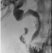 Figure 6a Check cholangiogram shows spontaneous further stent expansion with good flow into the duodenum.