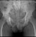 Fig 1. X-ray showing lytic lesion in right acetabulum