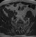 Fig 4. Axial MRI showing signal change to the sacroiliac joint