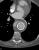 3 months post stent