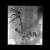 Tumour ingrowth pre covered stent