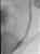 Post stenting