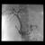 Post covered stent