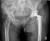 Trident Exeter cemented Total Hip Replacement