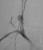 Carotid pseudoaneurysm with dissection