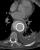 4 days post stent