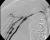 Severe stenosis at proximal end