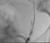 Pre stenting