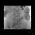 Post stent insertion