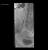 ballooning ureter 6mm