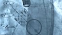 TAVI Edwards Sapien Transcatheter Heart Valve Insertion