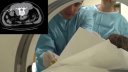 Percutaneous cryoablation of renal cancer